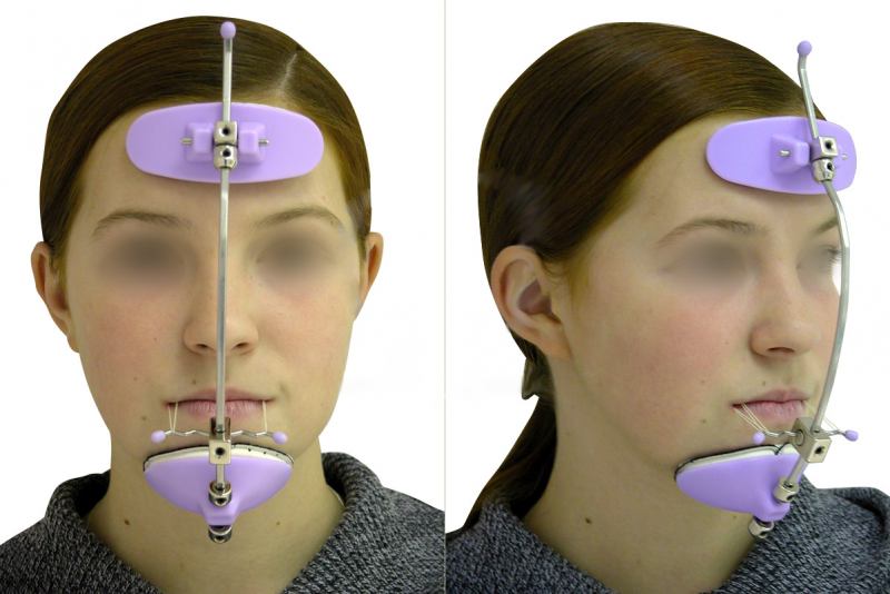 Лицевая маска ортодонтия фото